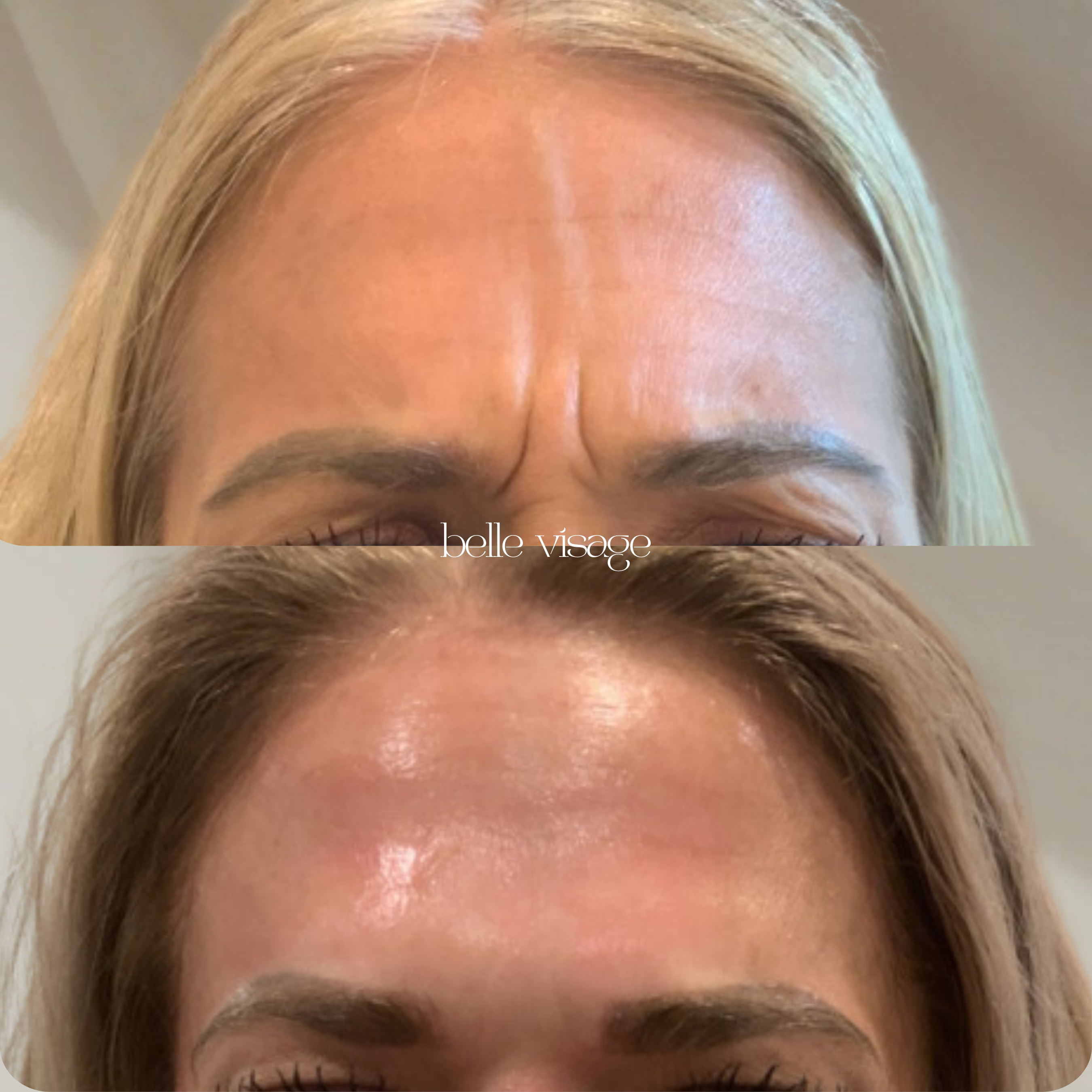 Tox Botox Dysport Xeomin Neurotoxin Treatment Burleson TX