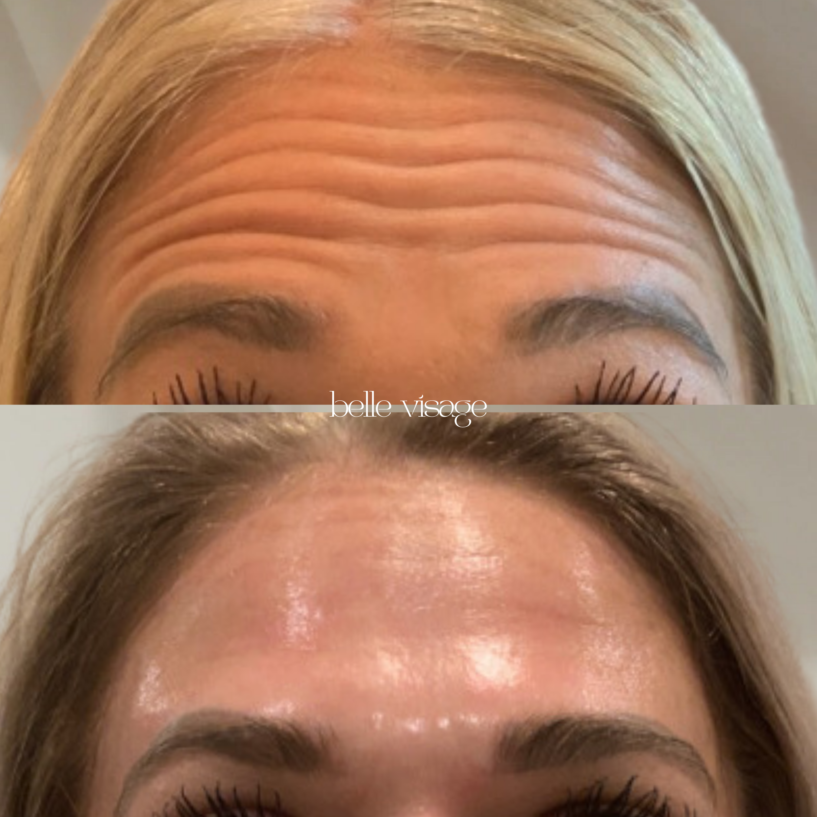 Tox Botox Dysport Xeomin Neurotoxin Treatment Burleson TX