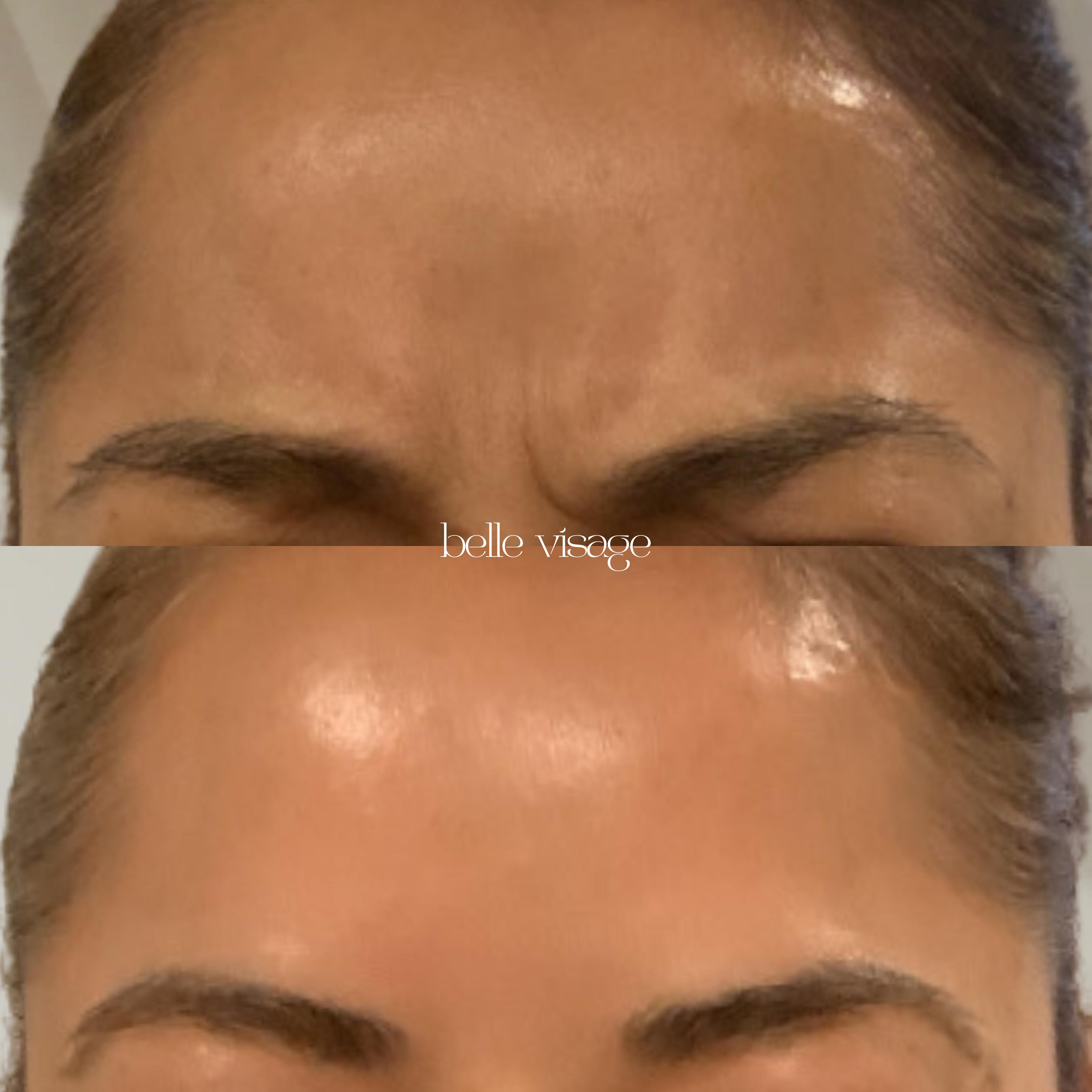 Tox Botox Dysport Xeomin Neurotoxin Treatment Burleson TX