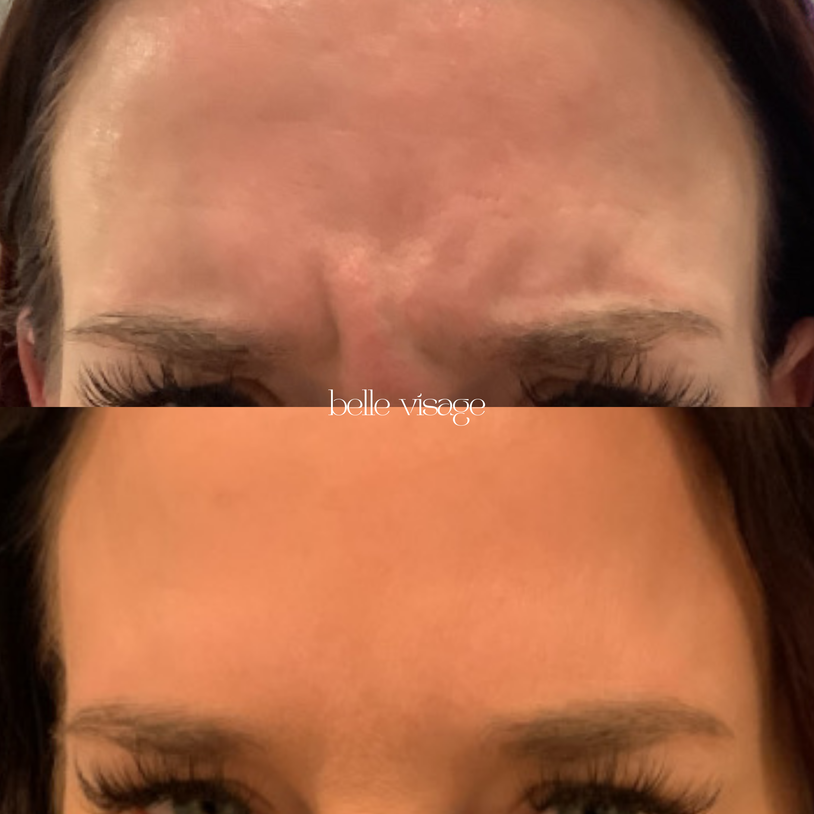 Tox Botox Dysport Xeomin Neurotoxin Treatment Burleson TX