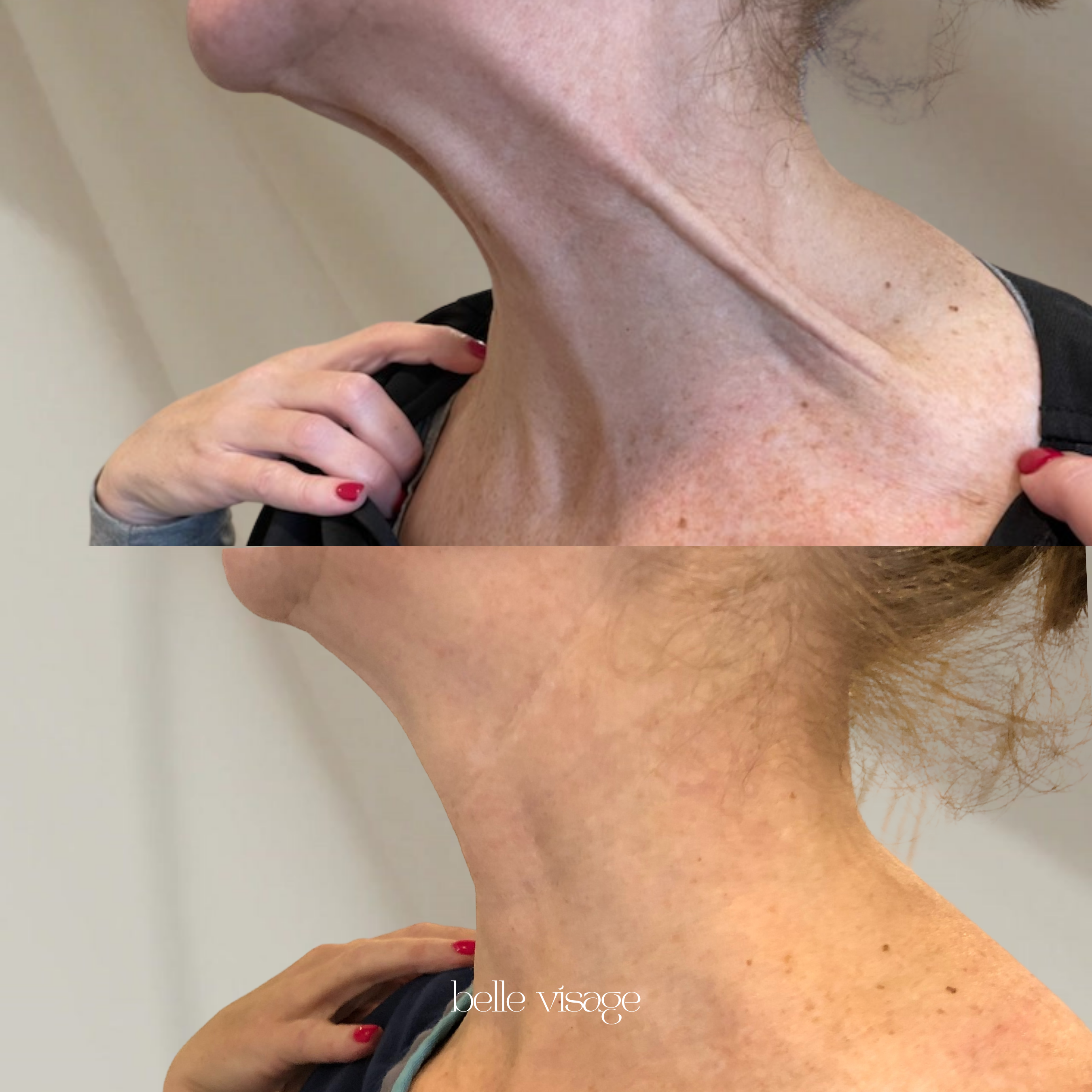 Tox Botox Dysport Xeomin Neurotoxin Treatment Burleson TX