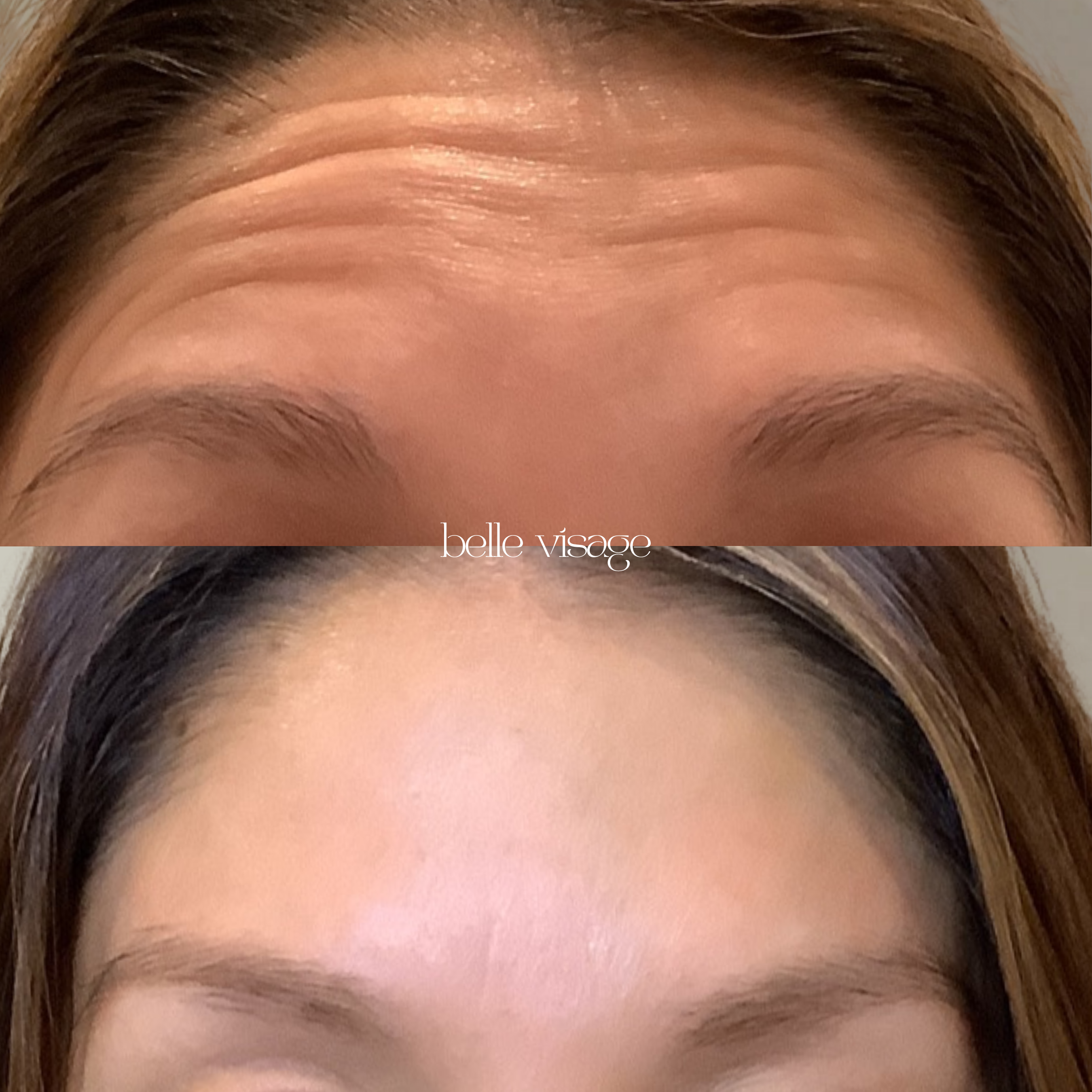 Tox Botox Dysport Xeomin Neurotoxin Treatment Burleson TX