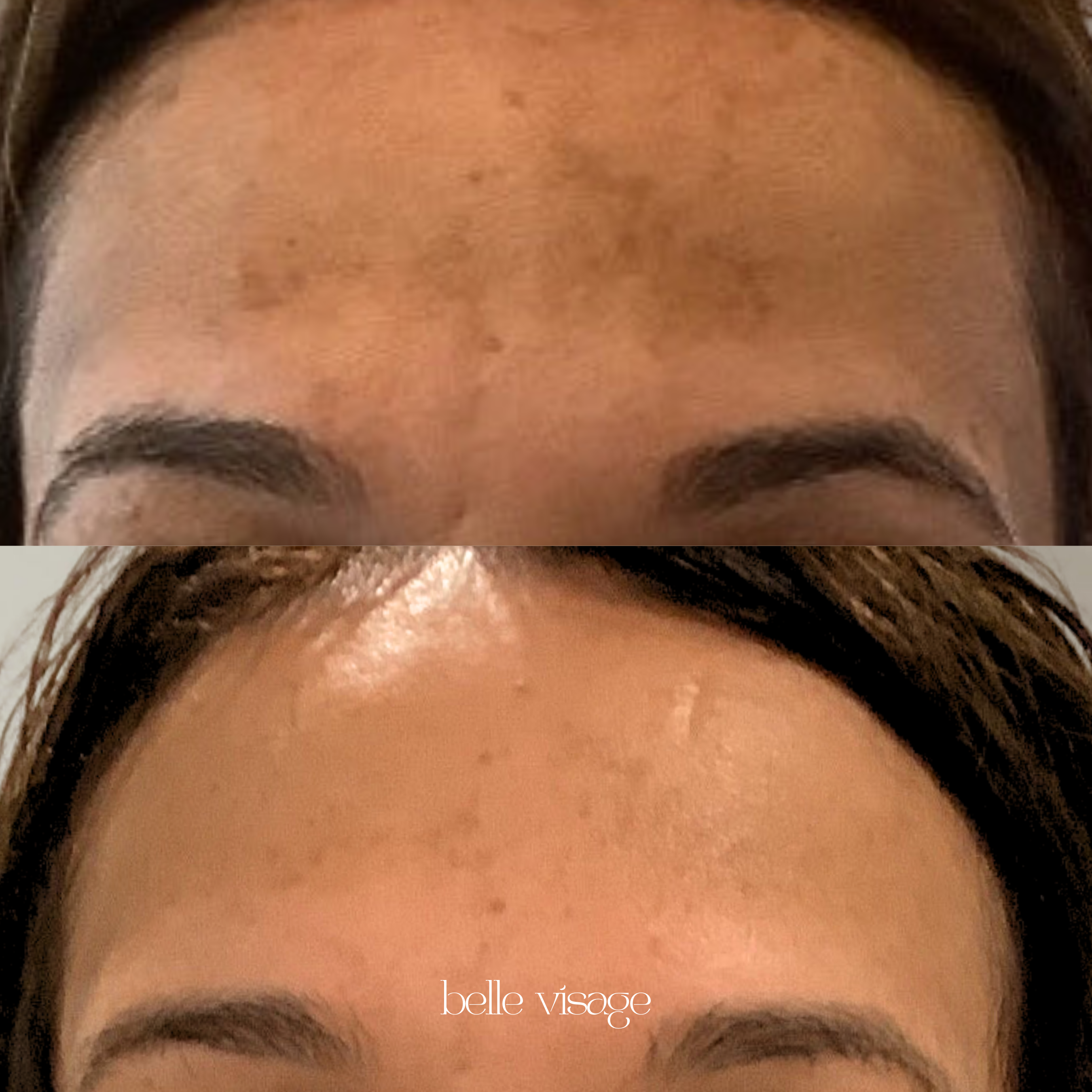 vi peel chemical peel facial treatment burleson tx