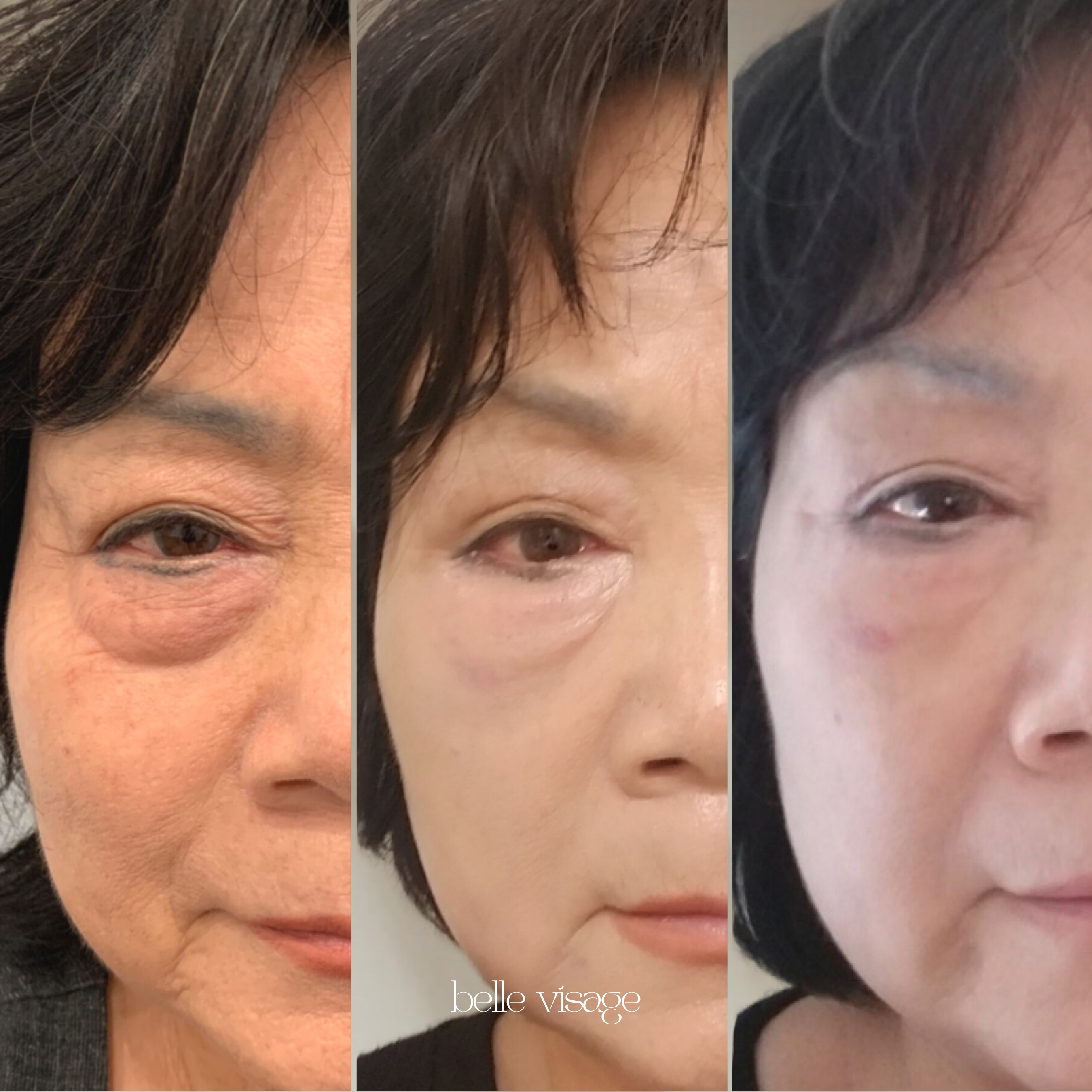 agnes radio frequency rf microneedling treatment burleson tx