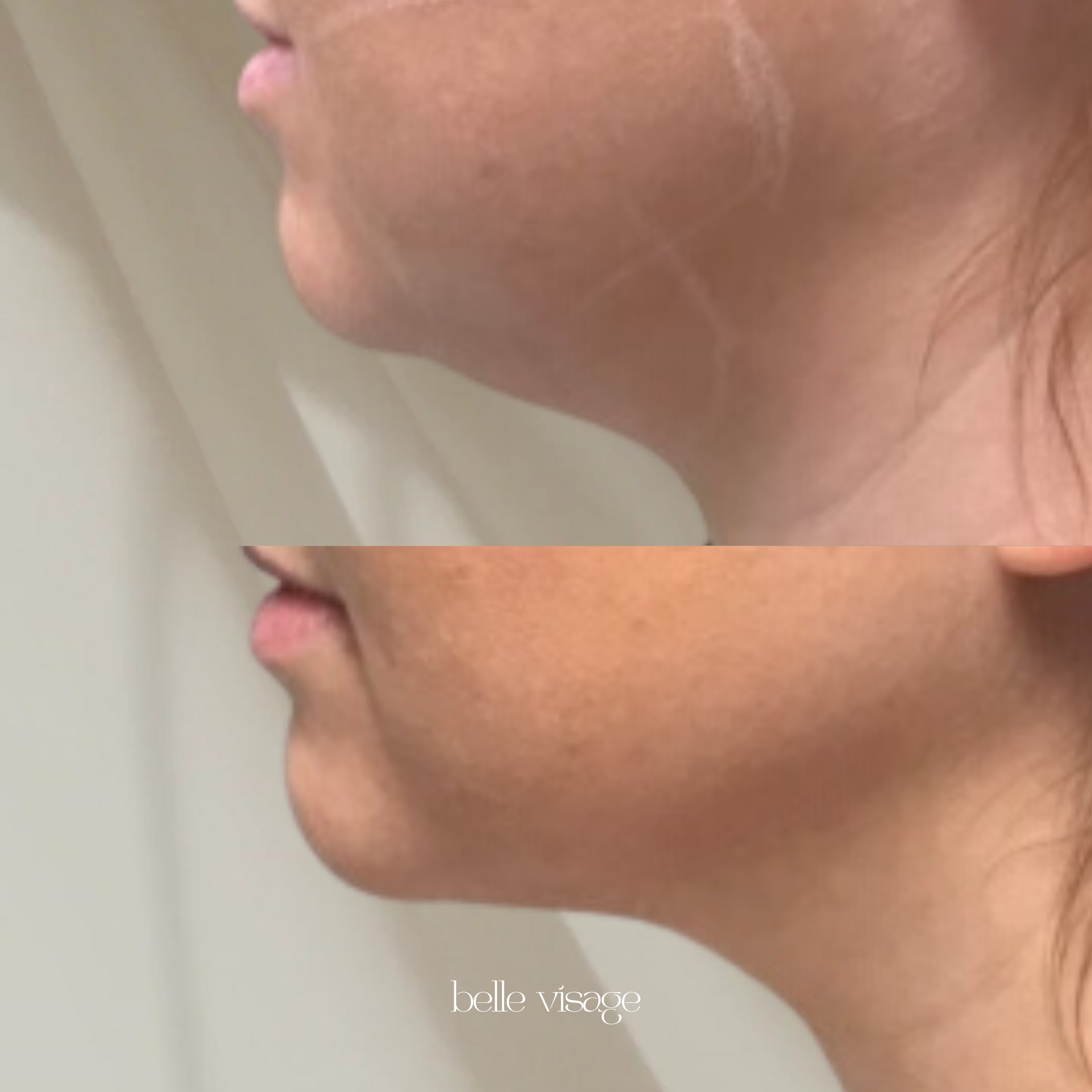 agnes radio frequency rf microneedling treatment burleson tx