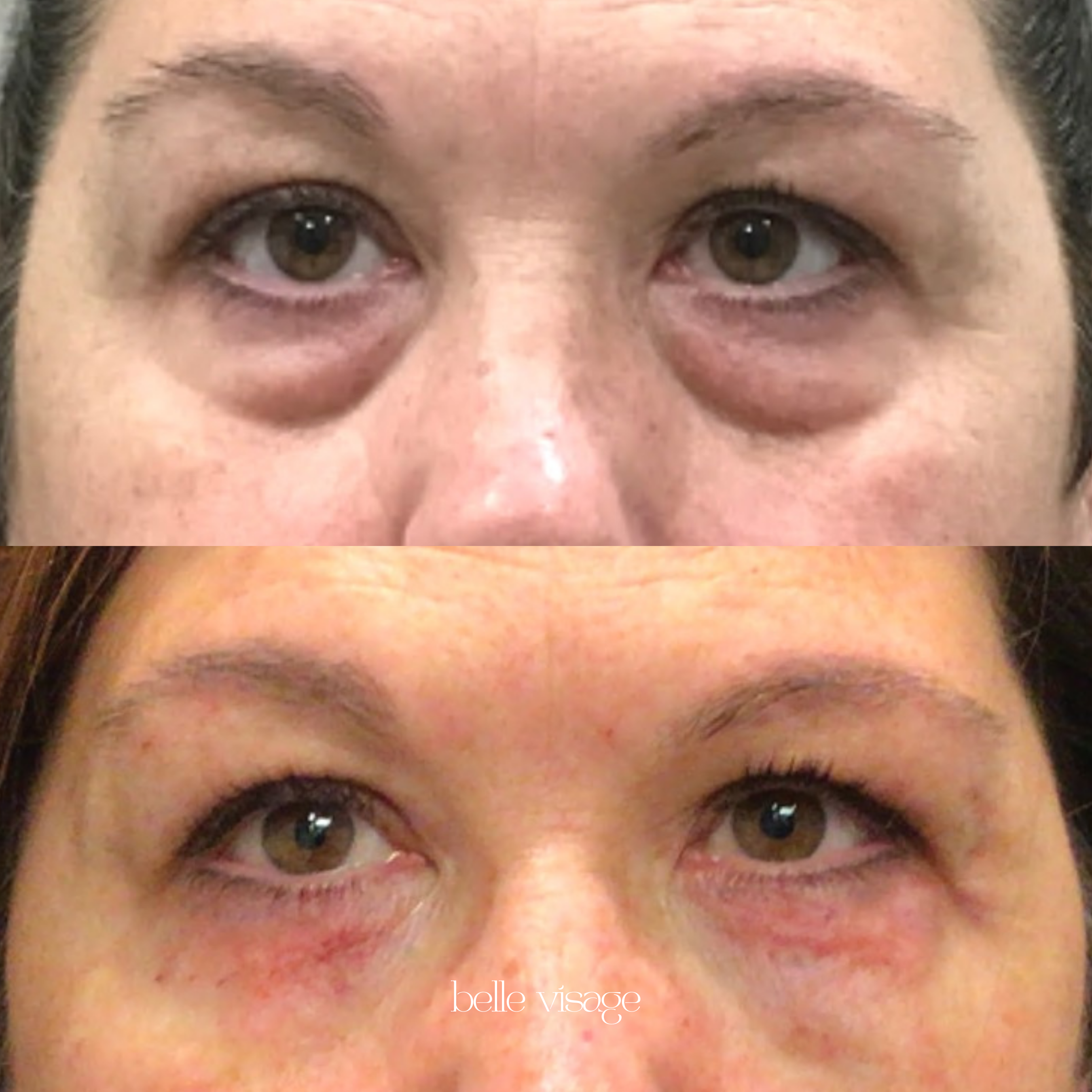 agnes radio frequency rf microneedling treatment burleson tx