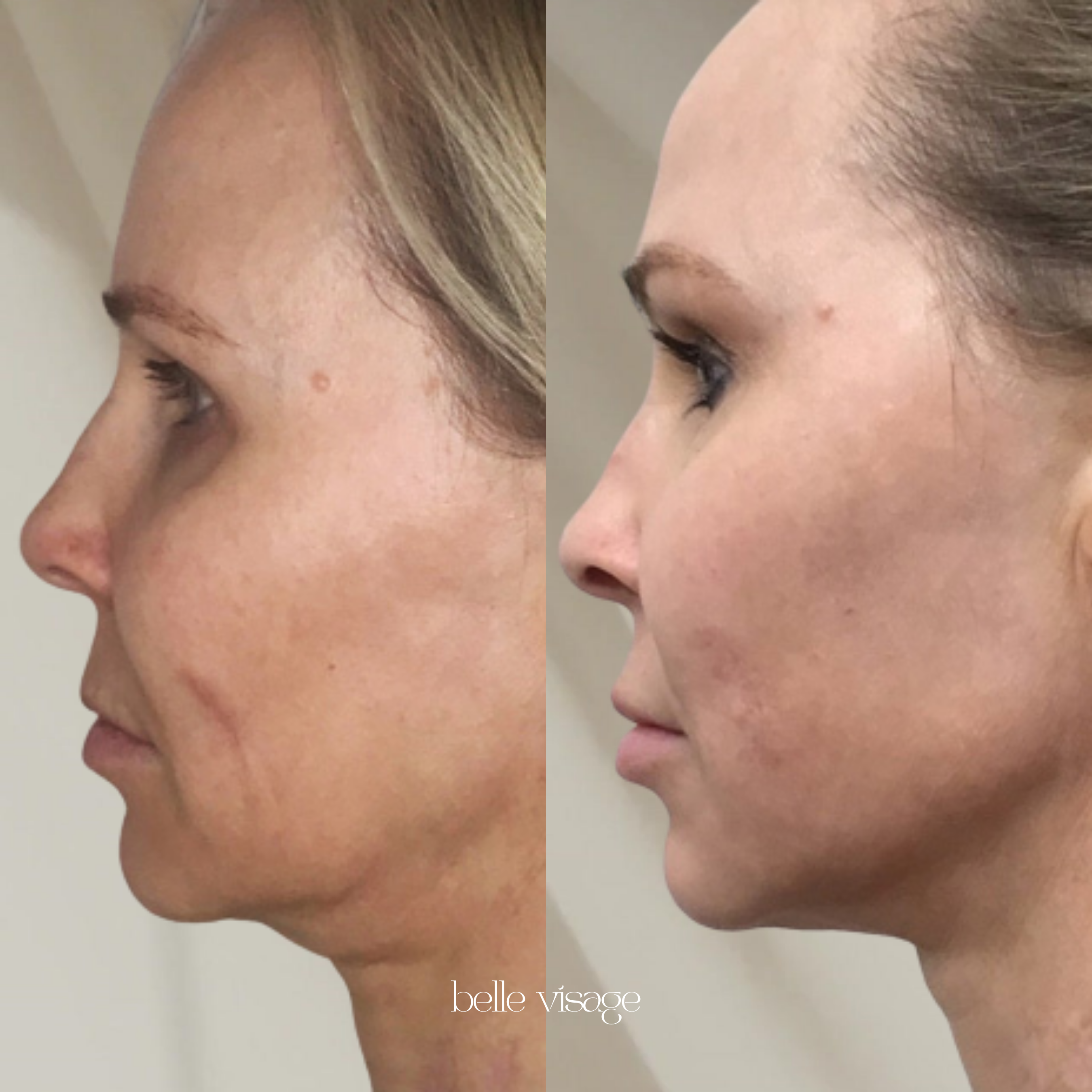agnes radio frequency rf microneedling treatment burleson tx
