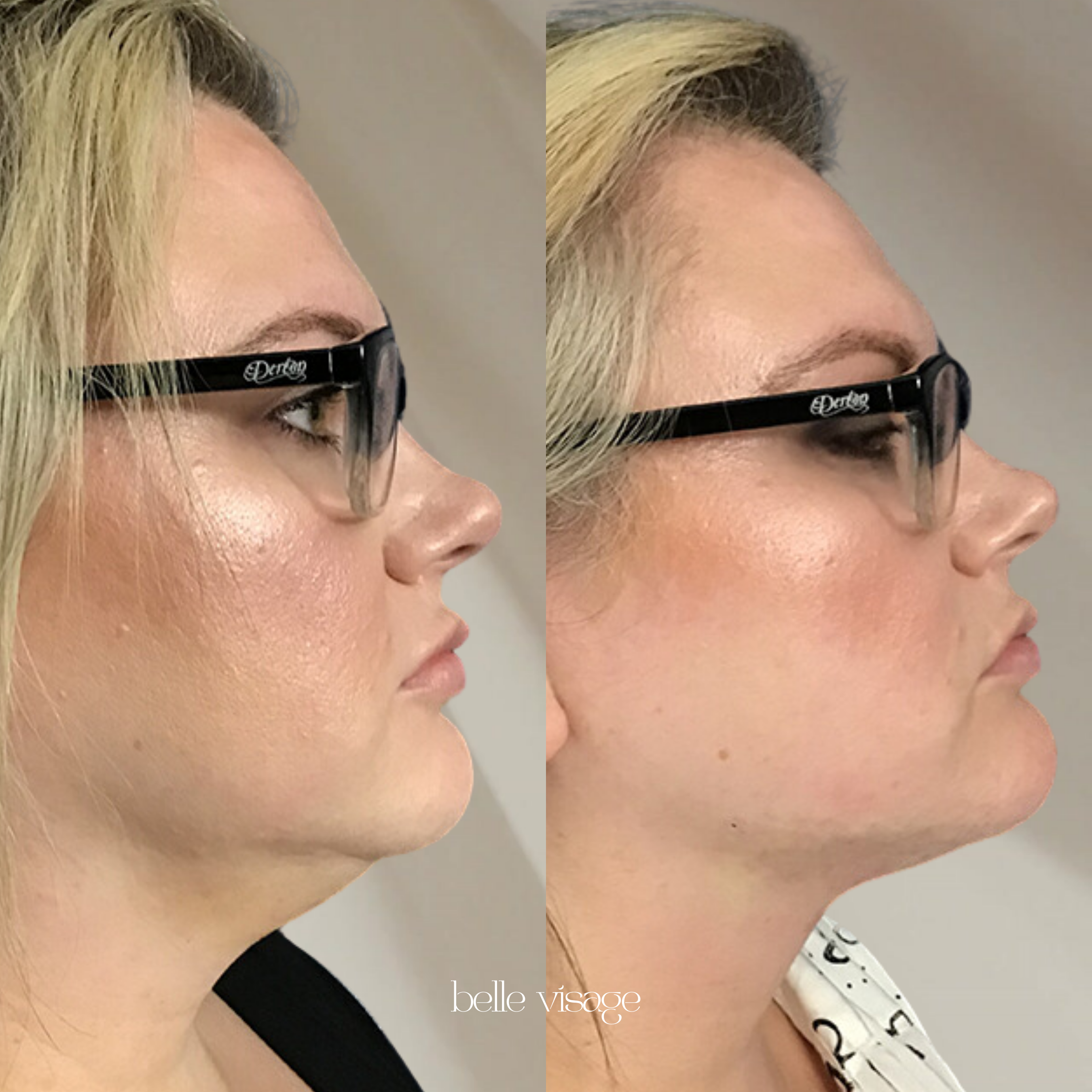 agnes radio frequency rf microneedling treatment burleson tx