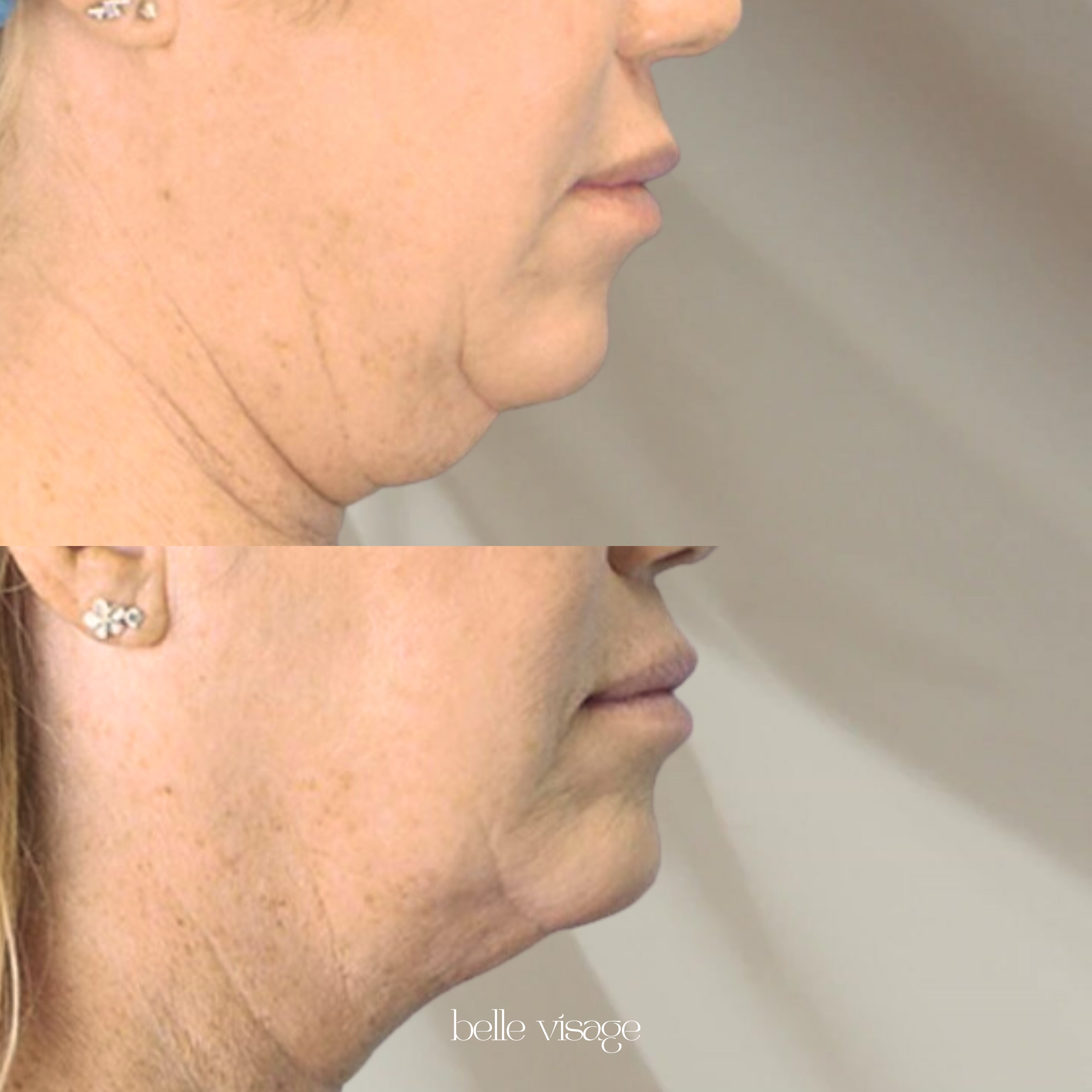 agnes radio frequency rf microneedling treatment burleson tx