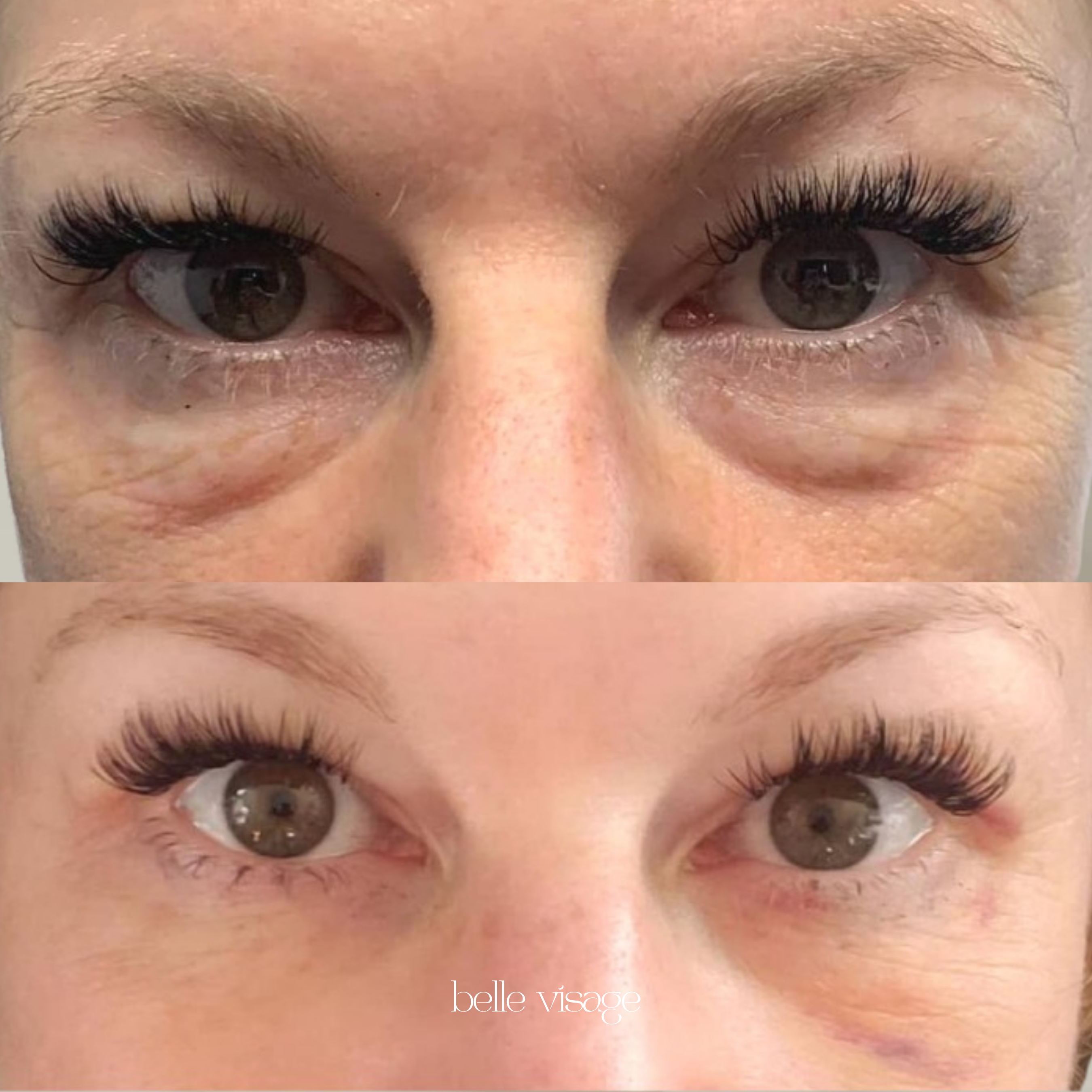 agnes radio frequency rf microneedling treatment burleson tx