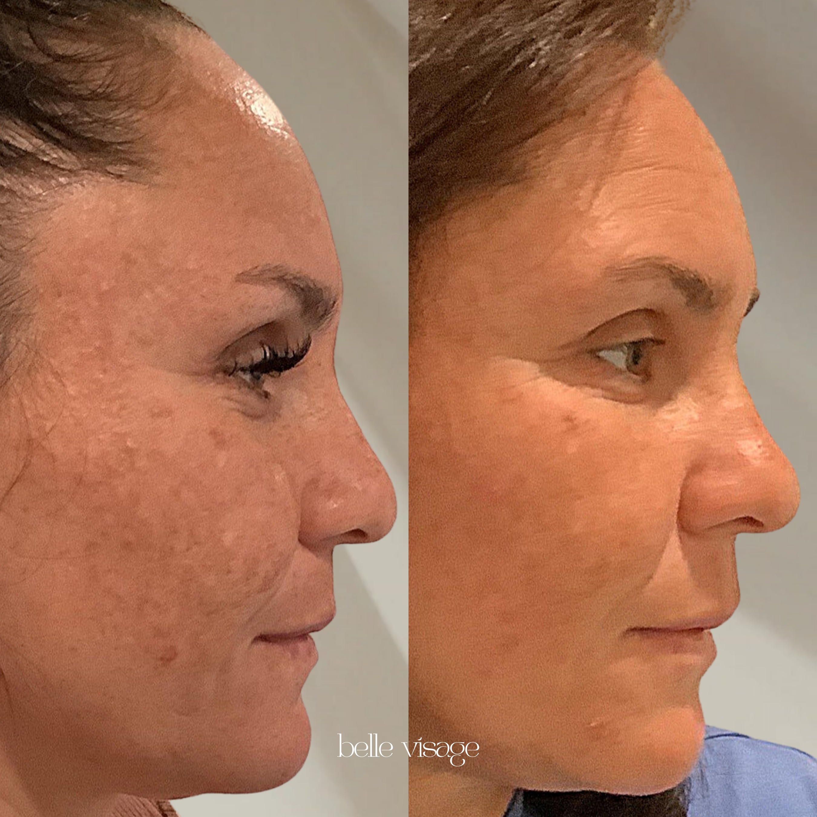 Microneedling treatment burleson tx