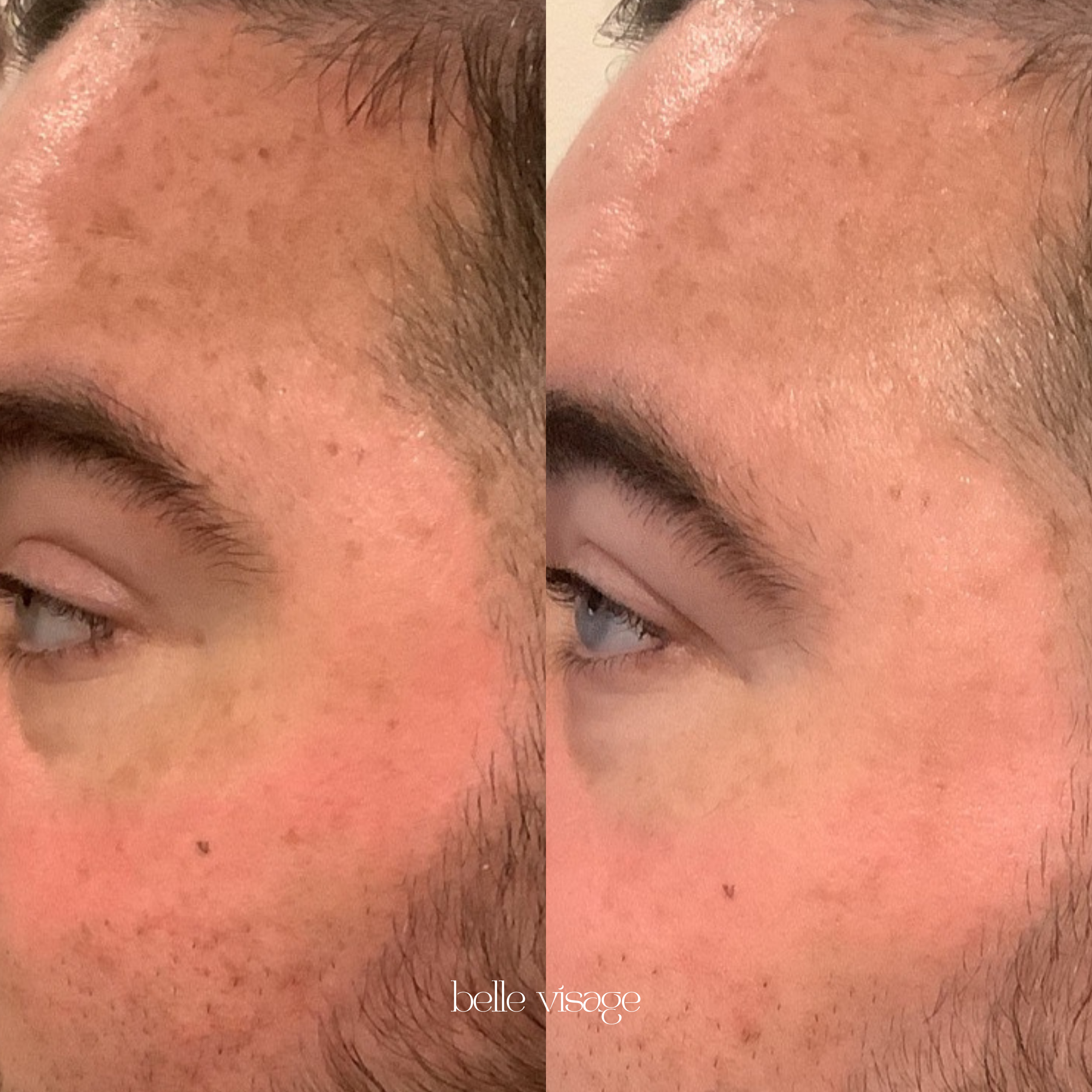 microneedling treatment burleson tx