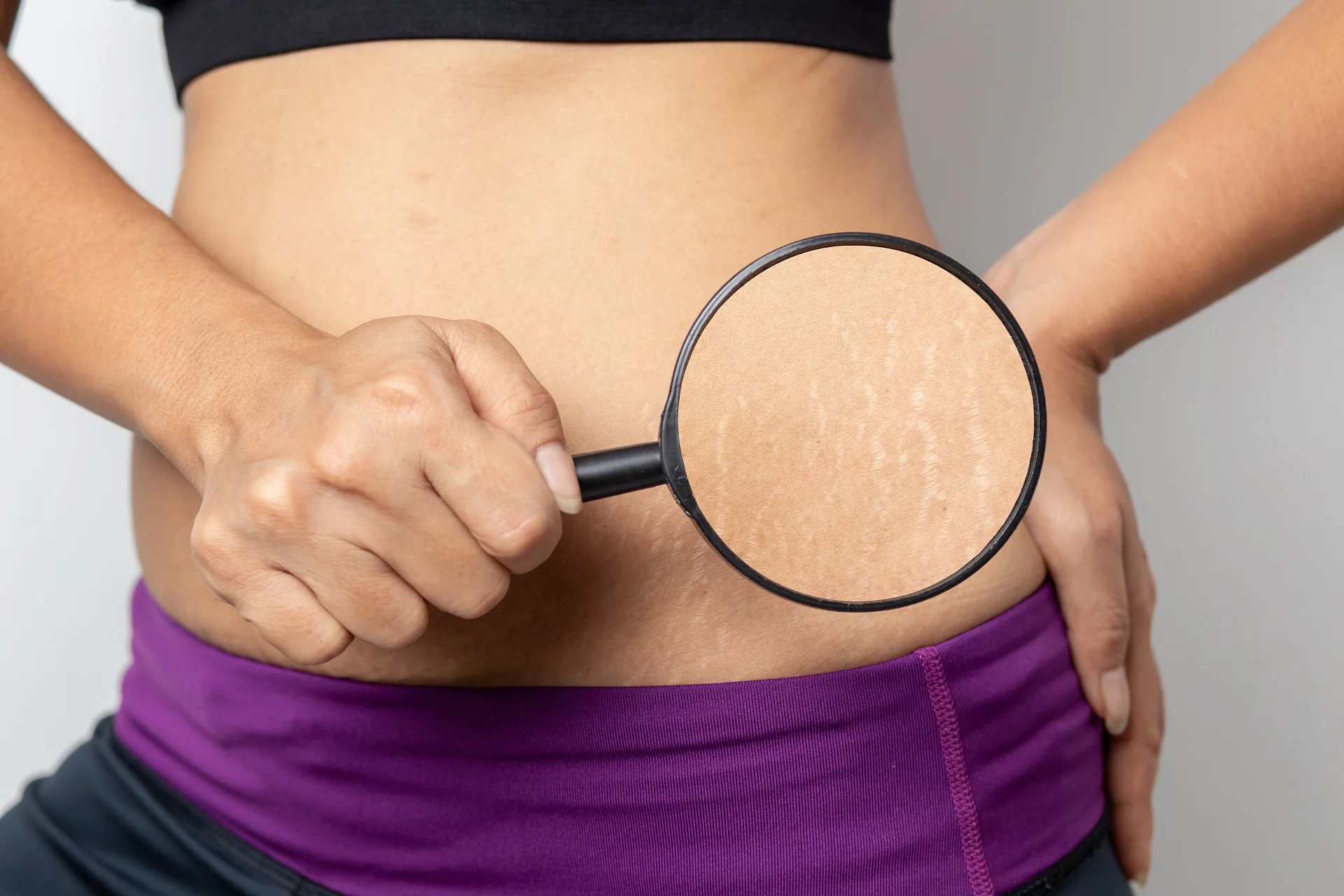 stretch marcks removal myths