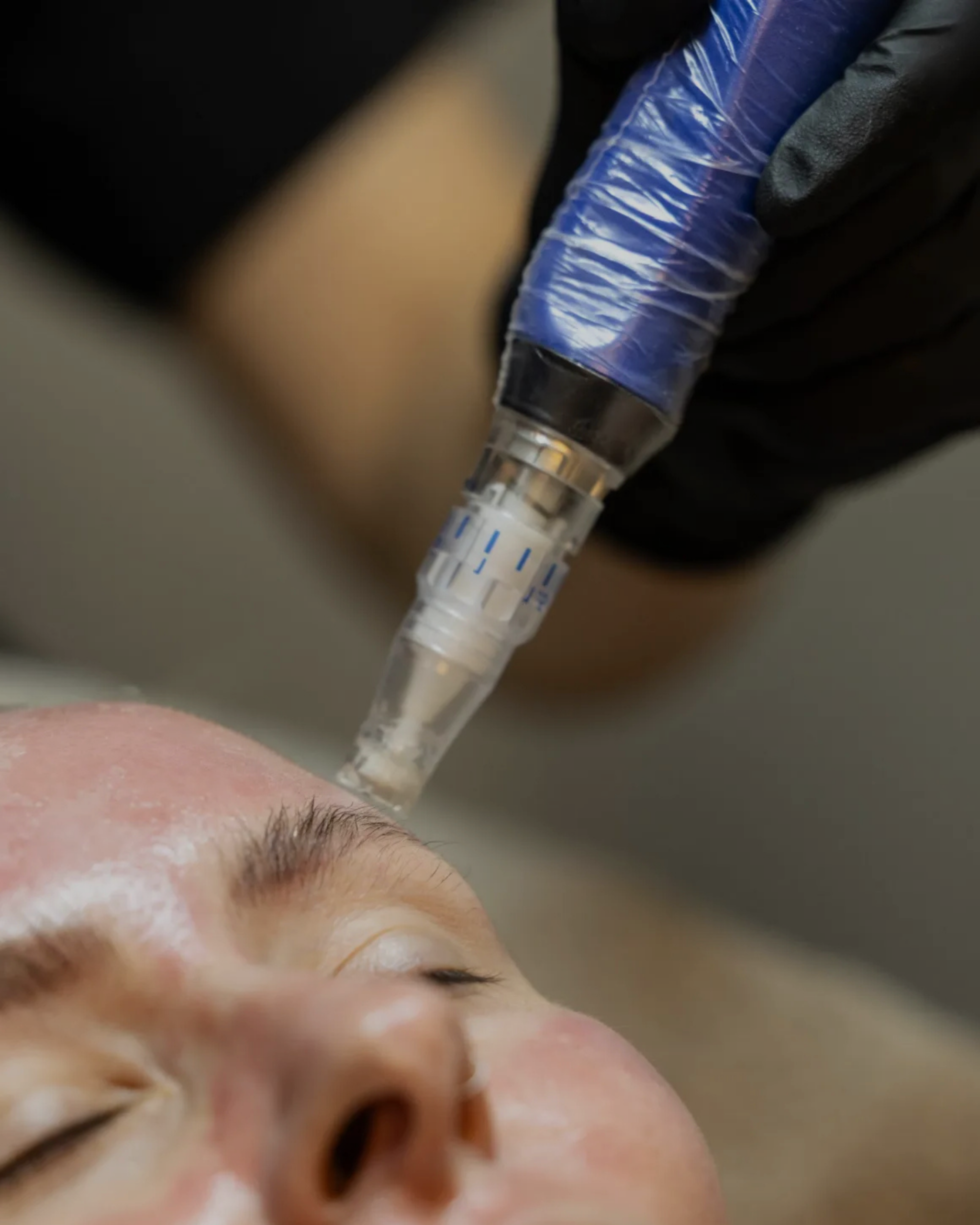 microneedling bvma
